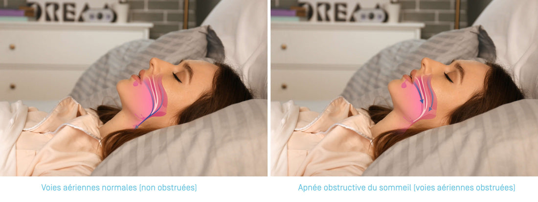 Tout savoir sur l’apnée du sommeil