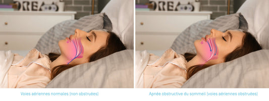 Tout savoir sur l’apnée du sommeil